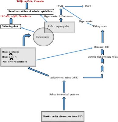 Posterior urethral valve in children: Using novel biomarkers as an early predictive tool for the onset and progression of chronic kidney disease